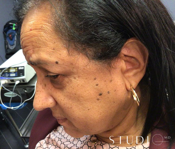 mole removal Manhattan results